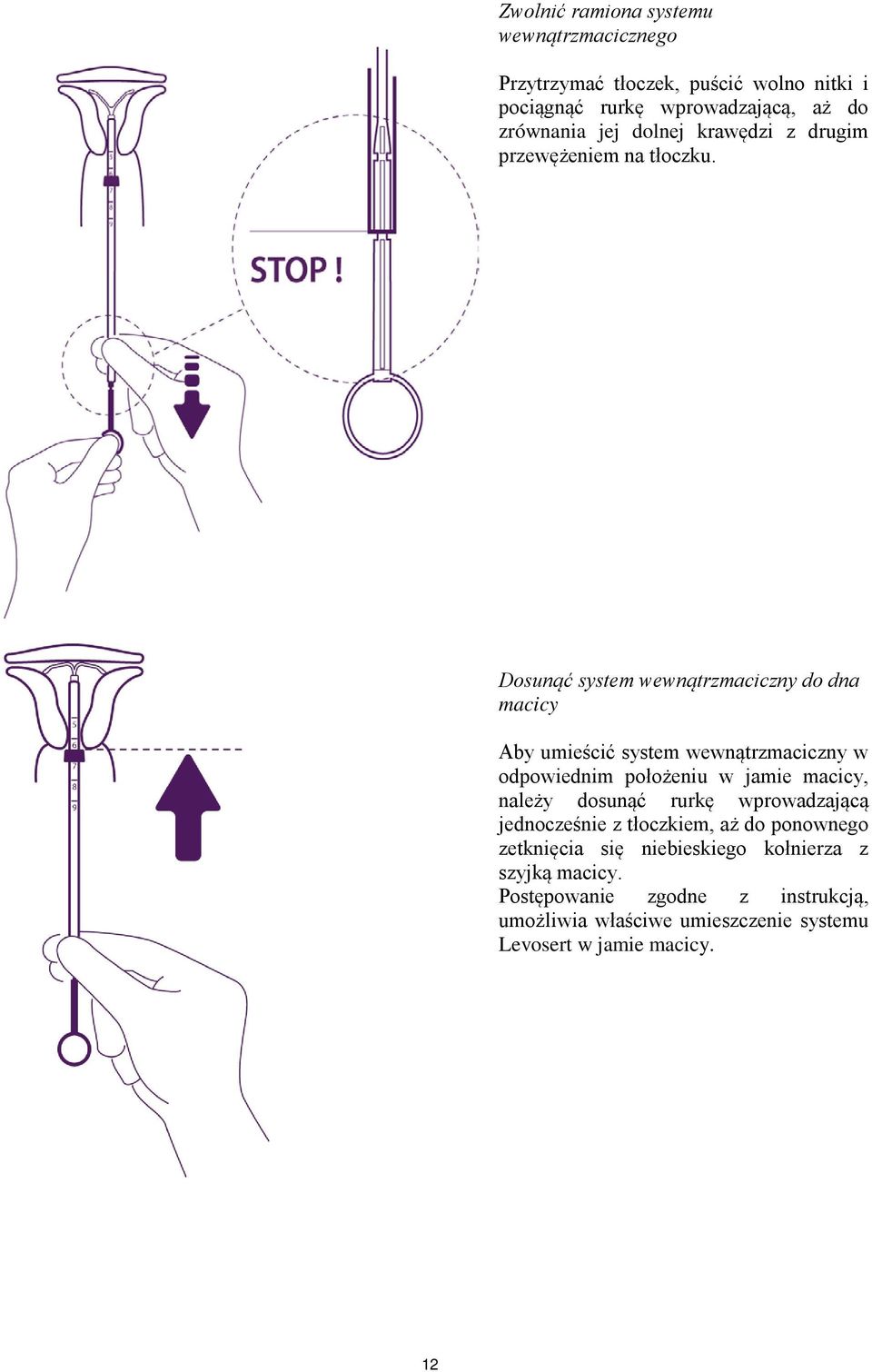 Dosunąć system wewnątrzmaciczny do dna macicy Aby umieścić system wewnątrzmaciczny w odpowiednim położeniu w jamie macicy, należy