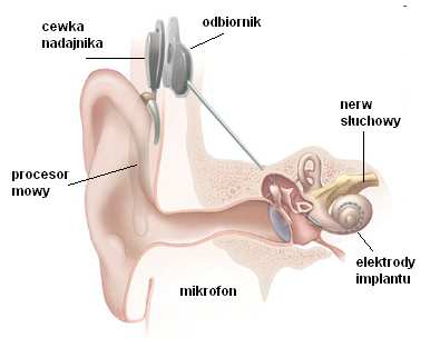 Protezowanie słuchu Implant ślimakowy Implant ślimakowy ma umożliwić zastąpienie funkcji uszkodzonych komórek receptorowych poprzez bezpośrednią elektryczną stymulację zakończeń nerwu słuchowego
