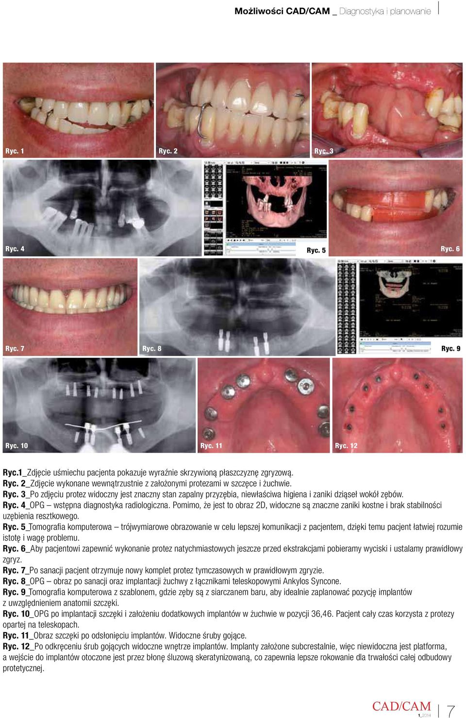 Ryc. 4_OPG wstępna diagnostyka radiologiczna. Pomimo, że jest to obraz 2D, widoczne są znaczne zaniki kostne i brak stabilności uzębienia resztkowego. Ryc.