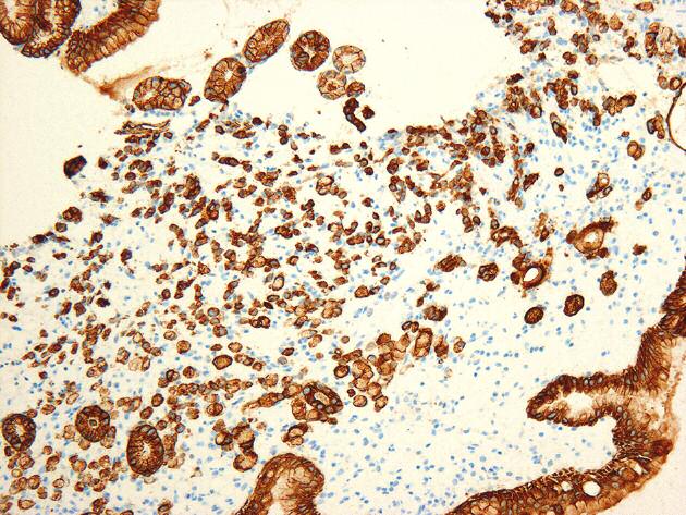 ANNA NASIEROWSKA-GUTTMEJER, PRZEMYSŁAW MAJEWSKI, MAŁGORZATA MALINOWSKA A B Rycina 6A. Rak bez kohezji (signet ring cell carcinoma). Barwienie mucikarminem na obecność śluzu Rycina 6B. Rak bez kohezji. Barwienie immunohistochemiczne z przeciwciałem przeciwko keratynie A Rycina 7.