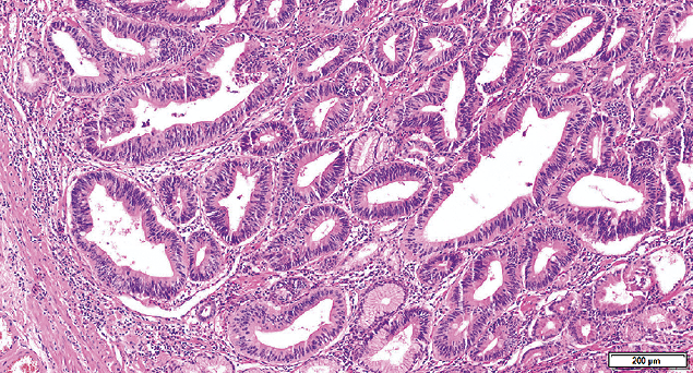 Rak z naciekiem limfocytarnym, HE rak gruczołowy podobny do wątrobowokomórkowego (hepatoid adenocarcinoma); rak płaskonabłonkowy (squamous cell carcinoma); rak niezróżnicowany (undifferentiated