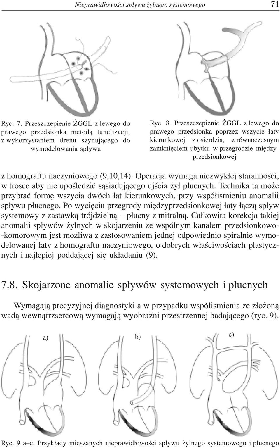 (9,10,14). Operacja wymaga niezwyk³ej starannoœci, w trosce aby nie upoœledziæ s¹siaduj¹cego ujœcia y³ p³ucnych.