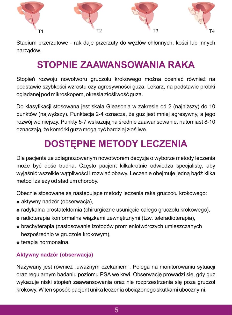 Lekarz, na podstawie próbki ogl¹danej pod mikroskopem, okreœla z³oœliwoœæ guza. Do klasyfikacji stosowana jest skala Gleason'a w zakresie od 2 (najni szy) do 10 punktów (najwy szy).
