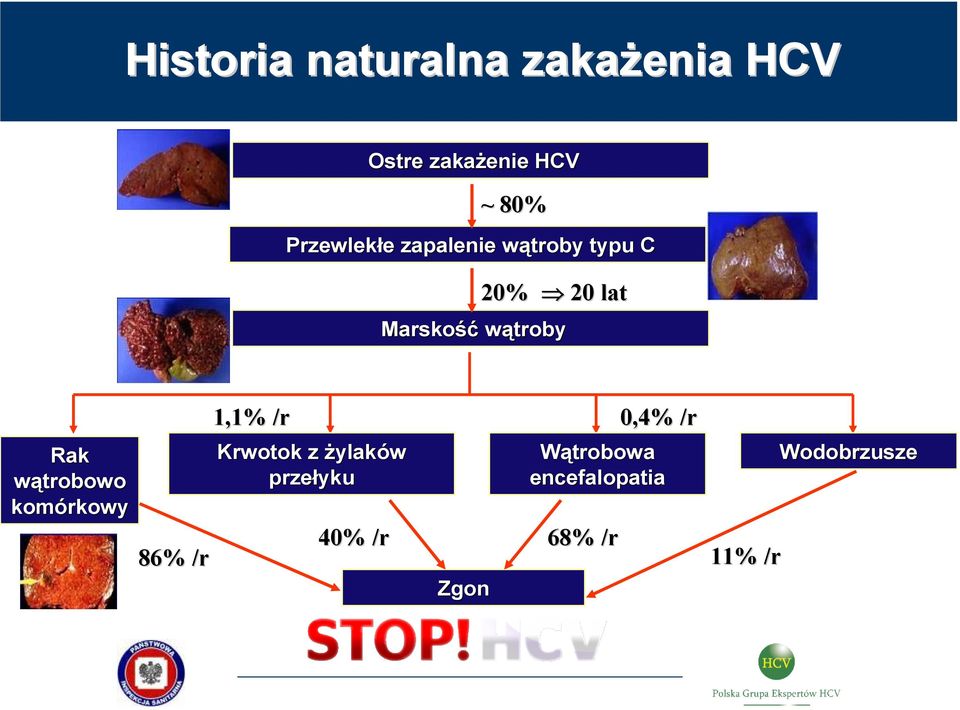 wątroby Rak wątrobowo komórkowy 86% /r 1,1% /r 0,4% /r Krwotok z