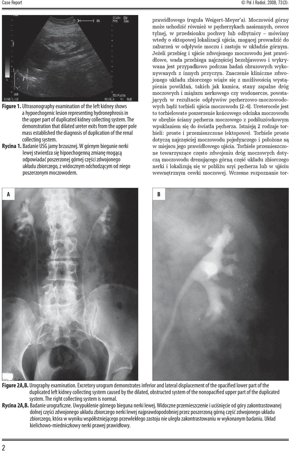 The demonstration that dilated ureter exits from the upper pole mass established the diagnosis of duplication of the renal collecting system. Rycina 1. Badanie USG jamy brzusznej.
