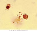 Neisseria gonorrhoeae dwoinka Gram-dodatnia w preparacie z wydzieliny z cewki moczowej Treponema