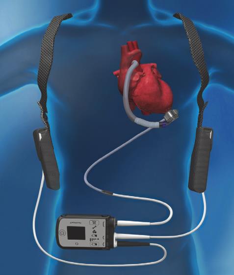 Pompy LVAD o przepływie ciągłym Heart Ware