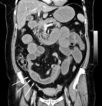 WYSOKA NIEDROŻNOŚĆ PRZEWODU POKARMOWEGO SPOWODOWANA KAMIENIEM ŻÓŁCIOWYM 21 Ryc. 3. Enterolitotomia. Obraz śródoperacyjny Fig. 3. Enterolithotomy, intraoperative view dolegliwości bólowych zlokalizowanych głównie w śródbrzuszu.
