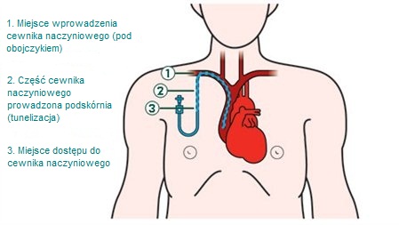 Podawanie chemioterapii przez wenflon wymaga zakładania nowego wenflonu bezpośrednio przed każdym zabiegiem i wyjmowana go przed wyjściem pacjenta do domu.