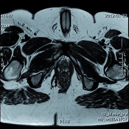 Endosonography and magnetic resonance imaging in the diagnosis of high anal ﬁstulae a comparison 3A 4A 3B 4B 4C Ryc. 3, 4.