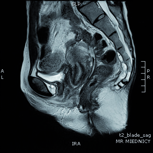 Endosonography and magnetic resonance imaging in the diagnosis of high anal fistulae a comparison własnej więcej ujść stwierdzono w AES.