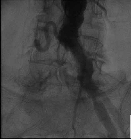 artosz Rymuza i wsp., Zasady diagnostyki i kwalifikacji do TAVI Rycina 6. Aortografia u pacjenta kwalifikowanego do przezcewnikowej implantacji zastawki aortalnej.