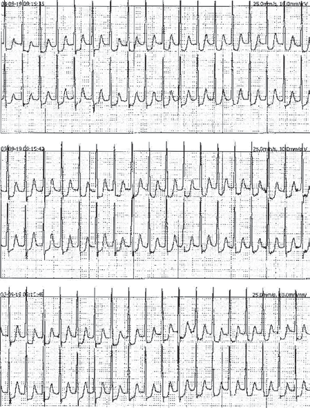 Folia Cardiologica Excerpta 2010, tom 5, nr 6 Tabela 3.