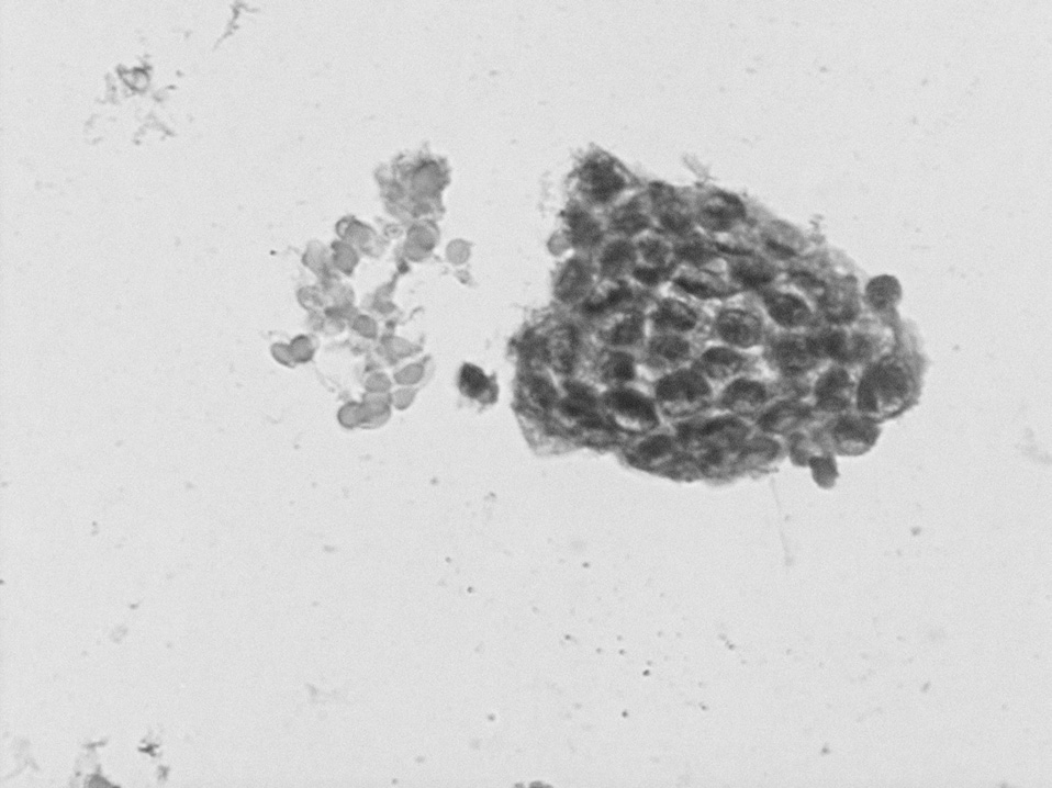 A jejunal stromal tumour in a patient with metastatic neuroendocrine cancer of unknown origin Ziad El Ali Figure 3.