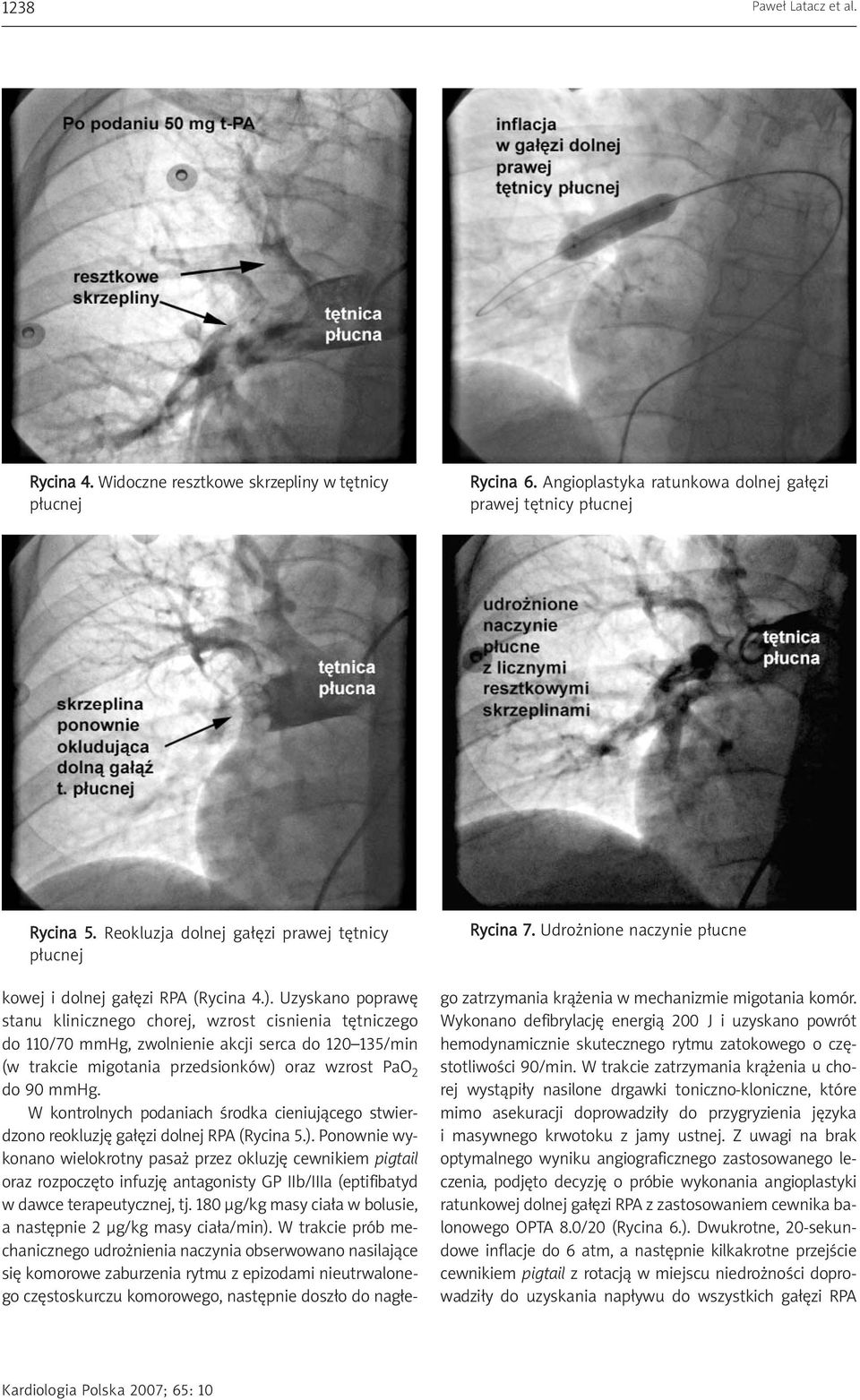 Uzyskano poprawę stanu klinicznego chorej, wzrost cisnienia tętniczego do 110/70 mmhg, zwolnienie akcji serca do 120 135/min (w trakcie migotania przedsionków) oraz wzrost PaO 2 do 90 mmhg.