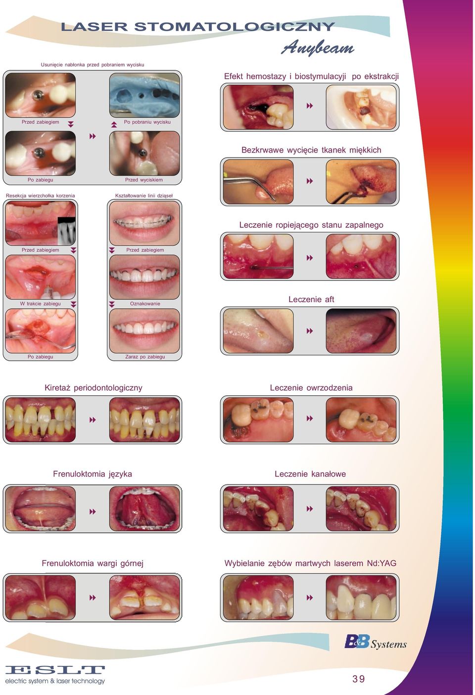ropiejącego stanu zapalnego W trakcie zabiegu Oznakowanie Leczenie aft Zaraz po zabiegu Kiretaż periodontologiczny