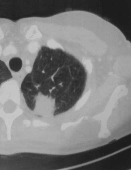 Onkologia w Praktyce Klinicznej 2014, tom 10, supl. G Erlotynib był pierwszym lekiem ukierunkowanym molekularnie, wprowadzonym do terapii raka płuca w Polsce.