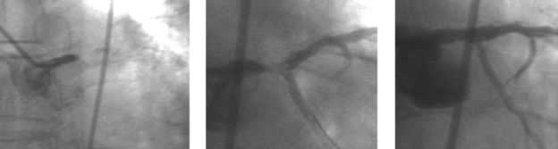 R. Gil i wsp., Istotne zwężenie pnia lewej tętnicy wieńcowej typ IV (tzw. równoważnik zwężenia LMS) zwężenie w odejściu od pnia zarówno LAD, jak i LCx, ale bez zajęcia dystalnego segmentu LMS.