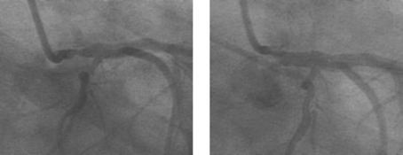 Folia Cardiol. 2003, tom 10, nr 2 Rycina 6. Ciasne zwężenie pnia lewej tętnicy wieńcowej przed i po zabiegu bezpośredniej implantacji stentu u chorego z ostrym zespołem wieńcowym Figure 6.