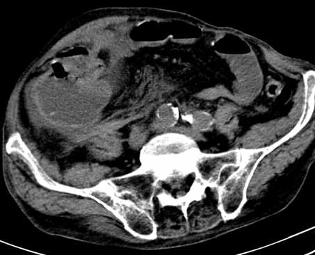 Treatment of ruptured abdominal aortic aneurysm with unoperative colon carcinoma, Wronski et al. Figure 1.