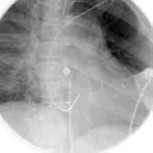 Folia Cardiol. 2002, tom 9, nr 6 efekt ablacji, zarówno wczesny, jak i odległy. U jednego pacjenta droga tylnoprzegrodowa była zlokalizowana w uchyłku zatoki wieńcowej.