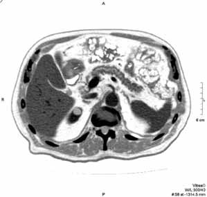 ONKOLOGIA W PRAKTYCE KLINICZNEJ 2010, tom 6, nr 3 A B C Rycina 1. Gruczolakorak trzustki.