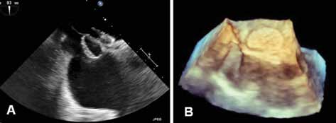 Folia Cardiologica 2015, tom 10, nr 4 stanie, z jedynie dyskretnym ośrodkowym prawostronnym niedowładem nerwu VII oraz parestezjami w obrębie prawej kończyny górnej.