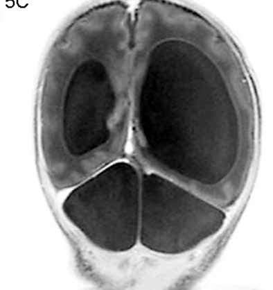 P R A C E O R Y G I N A L N E DOI: 10.17772/gp/57860 Ginekol Pol. 2015, 86, 774-781 Rycina 5C. UBadanie RM, obraz T2 zależny w płaszczyźnie czołowej.