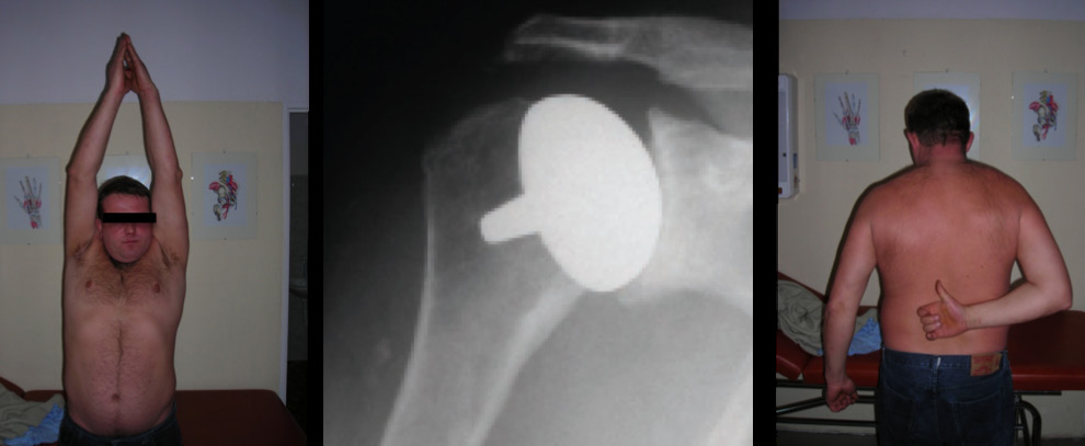 Figure 6. Range of motion of the upper limb in a patient with necrosis of the humeral head after resurfacing of the shoulder. Radiographic documentation. Rycina 6.