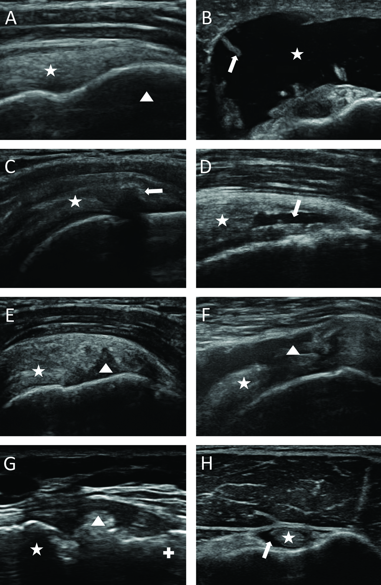 Correlation of findings in clinical and high resolution ultrasonography examinations of the painful shoulder Ryc.. Przykłady obrazów ultrasonograficznych stawu łopatkowo-ramiennego (43,44). A.
