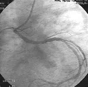 Folia Cardiol. 2003, tom 10, nr 6 Rycina 1. Pacjent A.K. (123/2001). Prawa tętnica wieńcowa angiografia przed zabiegiem Figure 1. Patient A.K. (123/2001). Right coronary artery angiography before intervention Rycina 2.