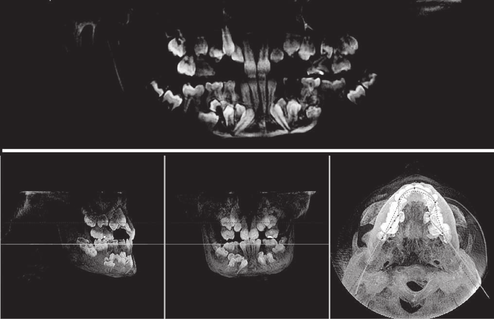 506 Bogumił Lewandowski et al. rib deformation, as illustrated in figure 3. The X-ray of the pelvic girdle made in early childhood showed the acetabular hypoplasia (fig. 4).