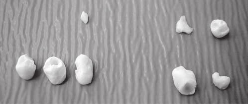 Multiple, supernumerary retained teeth in the course of cleido-cranial dysplasia 507 Fig. 7.