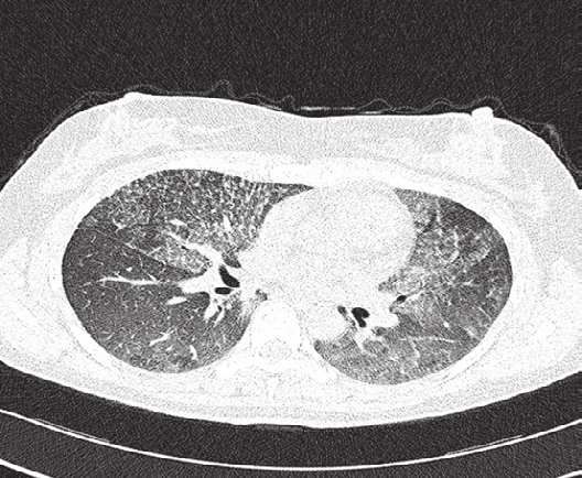 Pneumonologia i Alergologia Polska 2012, tom 80, nr 1, strony 82 86 A B Rycina 1. Radiogram klatki piersiowej w projekcji PA (z 14.06.