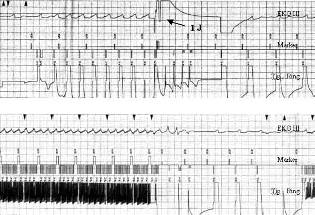 M. Kempa i wsp., Indukcja migotania komór u chorych z ICD Rycina 2. Rejestracja nieudanej próby wywołania migotania komór u chorego H.P.