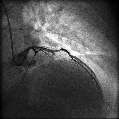 Otwieranie przewlekłej okluzji tętnicy wieńcowej dlaczego, kiedy i jak? 193 czyną niepowodzenia rekanalizacji CTO u ok.