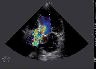 RYCINA 15 Niestabilność protezy aortalnej (proteza przesunięta w głąb aorty wstępującej nad zatokę Valsalvy). udaru.