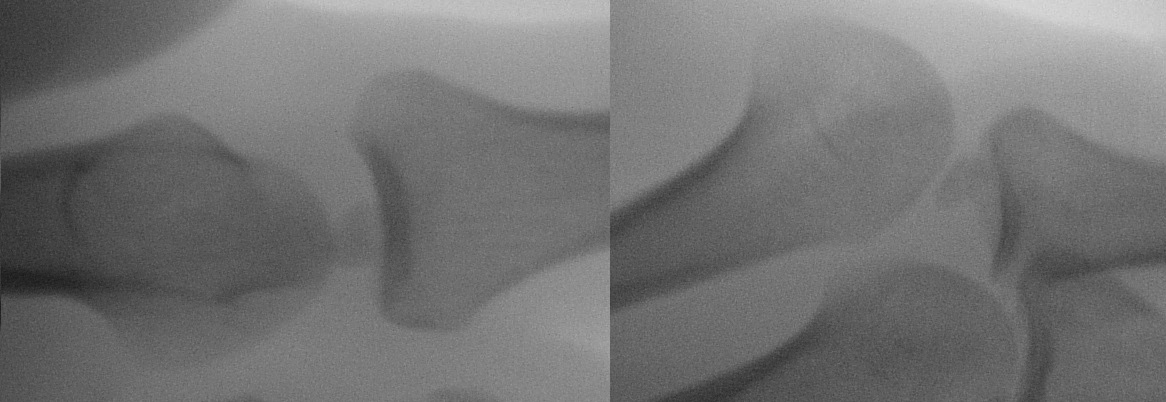 Piątkowski K. et al. Surgical Treatment of Dislocation of the Second Metacarpophalangeal Joint wykonano zdjęcie radiologiczne (Ryc. 1), które potwierdziło rozpoznanie.