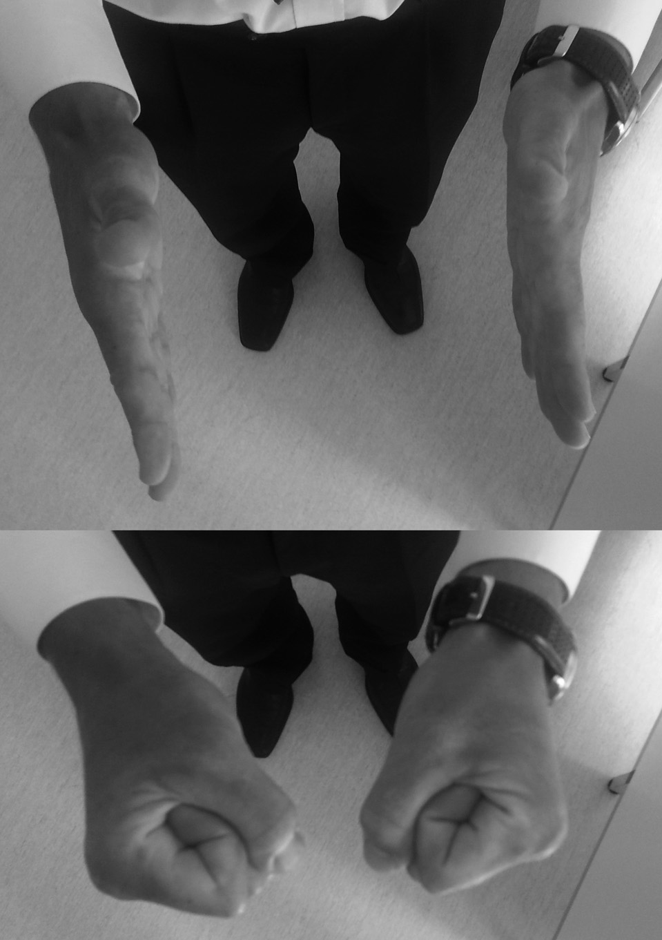 Piątkowski K. et al. Surgical Treatment of Dislocation of the Second Metacarpophalangeal Joint Ryc. 4a-b. Fotografia chorego dwa miesiące od leczenia operacyjnego.