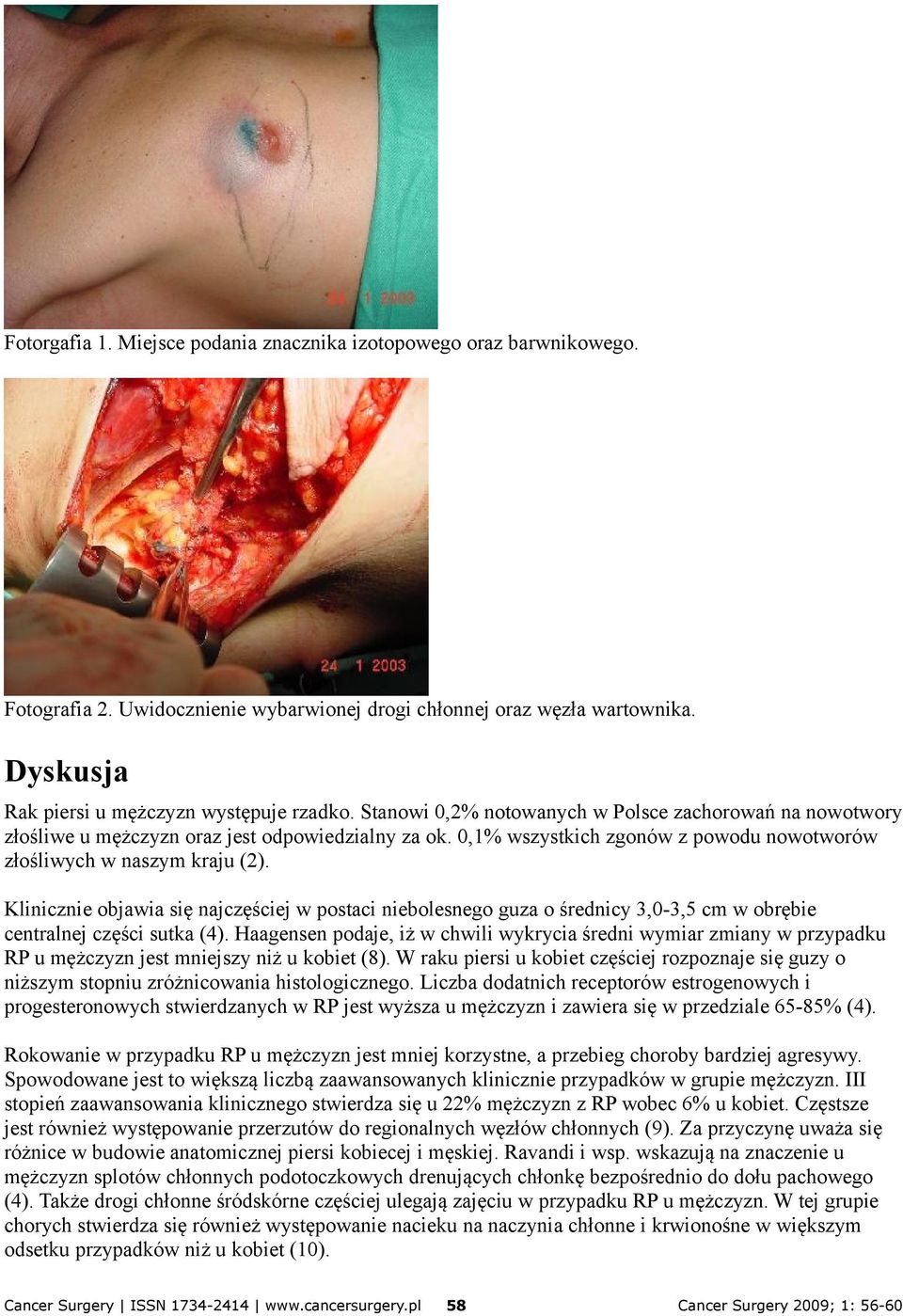 Klinicznie objawia się najczęściej w postaci niebolesnego guza o średnicy 3,0-3,5 cm w obrębie centralnej części sutka (4).