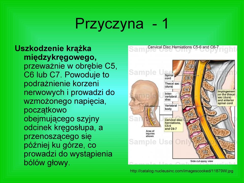 początkowo obejmującego szyjny odcinek kręgosłupa, a przenoszącego się później ku