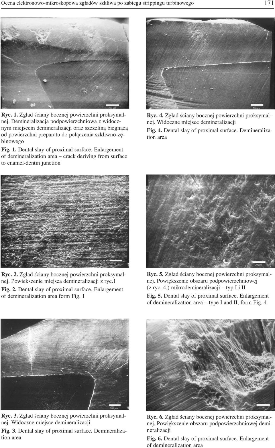 Enlargement of demineralization area crack deriving from surface to enamel dentin junction Ryc. 4. Zgład ściany bocznej powierzchni proksymal nej. Widoczne miejsce demineralizacji Fig. 4. Dental slay of proximal surface.
