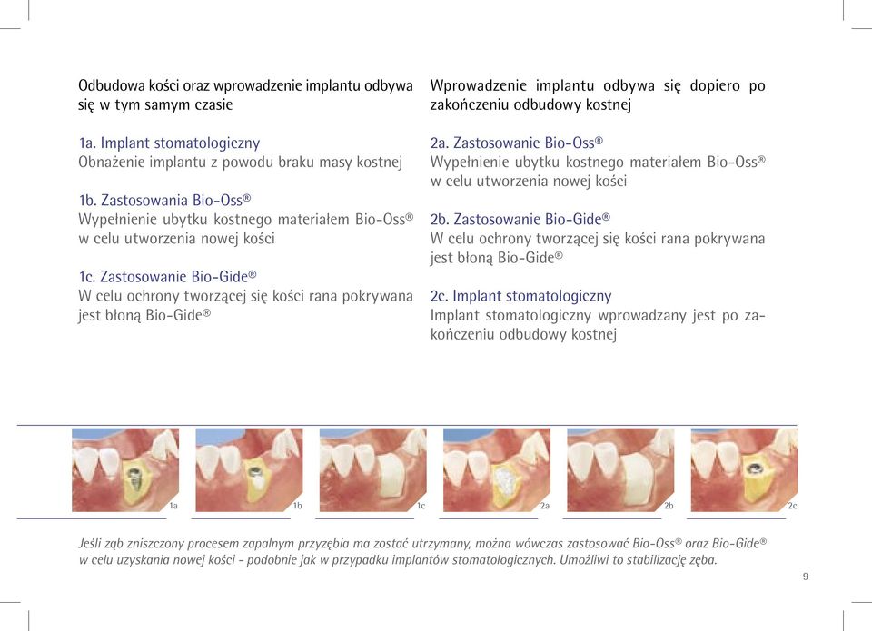 Zastosowanie Bio-Gide W celu ochrony tworzącej się kości rana pokrywana jest błoną Bio-Gide Wprowadzenie implantu odbywa się dopiero po zakończeniu odbudowy kostnej 2a.