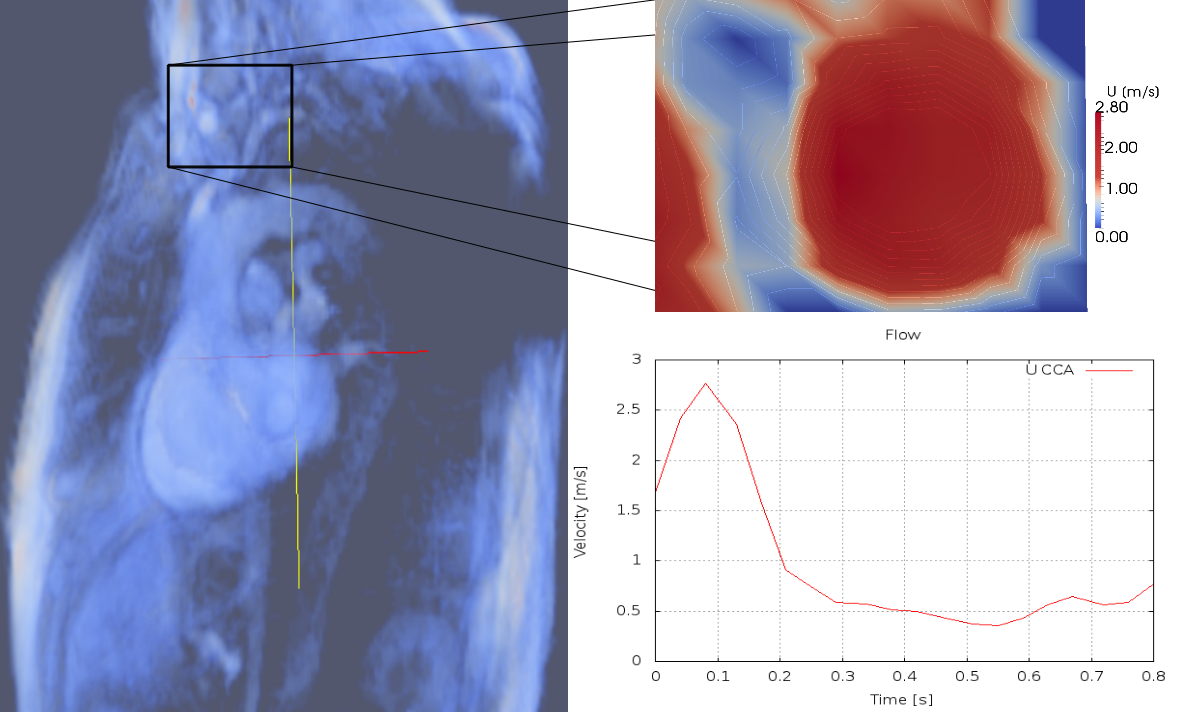 2.2 Segmentacja 2 ANALIZA DANYCH BIOMEDYCZNYCH Rysunek 1: Rekonstrukcja aorty na podstawie danych CT wykonana za pomocą programu 3D Slicer. metody najlepiej pasowały do analizowanych danych.