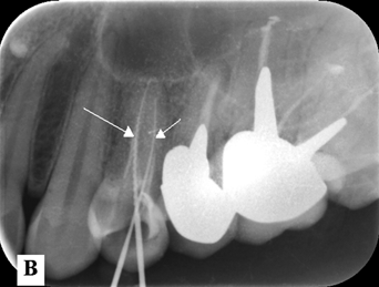 96 TERESA MIKOŁAJCZAK, GRAŻYNA WILK Zastosowanie projekcji skośnej w endodoncji 1) Identyfikacja nakładających się na siebie kanałów oraz wykrycie kanałów dodatkowych Największy problem z