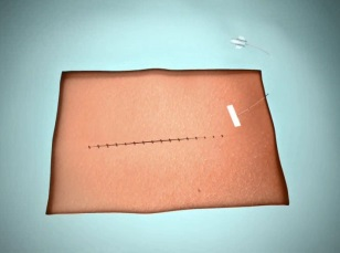 Analgezja pooperacyjna przy użyciu cewników implantowanych do rany: zapewnia skuteczną analgezję pooperacyjną - optymalnie jako składowa analgezji multimodalnej stosowana w wielu specjalnościach
