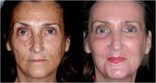 Peeling fenolowy (Exoderm lift) Jest to najgłębiej i najsilniej działający peeling.
