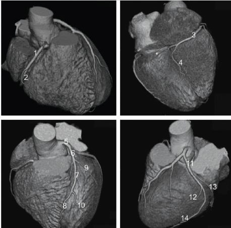 + Anatomia radiologiczna klatki piersiowej n Ocena serca: naczynia