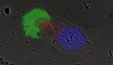 Analiza immunofluorescencyjna (IF) rzęsek w komórkach nabłonka oddechowego Podobnie jak TEM, dostarcza informacji nt defektu ultrastruktury Marker MT