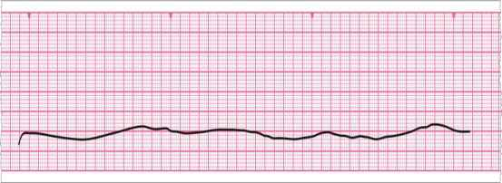 Oceń rytm defibrylacja- - leki Adrenalina 1mg Adrenalina 1mg